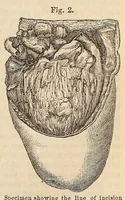 Picture 11 of 15 from The American journal of the medical sciences (1827), leaf 147