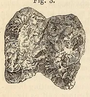 An illustration from The American journal of the medical sciences (1827)