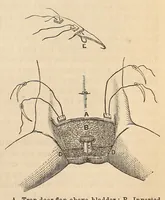 An illustration from The American journal of the medical sciences (1827)