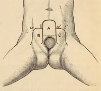 Picture 3 of 13 from The American journal of the medical sciences (1827), leaf 73