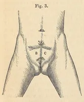 Picture 5 of 13 from The American journal of the medical sciences (1827), leaf 74