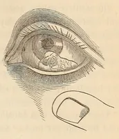 An illustration from The American journal of the medical sciences (1827)