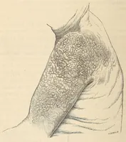 Picture 10 of 11 from The American journal of the medical sciences (1827), leaf 416