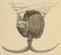 An illustration from The American journal of the medical sciences (1827)