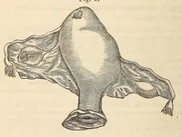 Picture 3 of 12 from The American journal of the medical sciences (1827), leaf 100