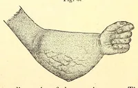 An illustration from The American journal of the medical sciences (1827)