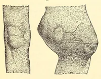 An illustration from The American journal of the medical sciences (1827)
