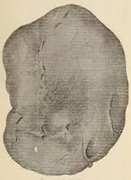 An illustration from The American journal of the medical sciences (1827)
