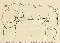 Picture 4 of 12 from The American journal of the medical sciences (1827), leaf 161