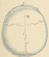 Picture 7 of 12 from The American journal of the medical sciences (1827), leaf 441