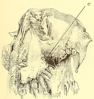 An illustration from The American journal of the medical sciences (1827)