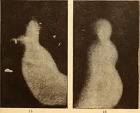 An illustration from Animismus und spiritismus. Versuch einer kritischen prüfung der mediumistischen phänomene mit besonderer berücksichtigung der hypothesen der hallucination und des unbewussten. Als entgegnung auf Ed. v. Hartmann's Werk: "Der spiritismus." (1894)