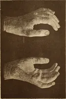 An illustration from Animismus und spiritismus. Versuch einer kritischen prüfung der mediumistischen phänomene mit besonderer berücksichtigung der hypothesen der hallucination und des unbewussten. Als entgegnung auf Ed. v. Hartmann's Werk: "Der spiritismus." (1894)