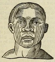 An illustration from Anthropometamorphosis: man transform'd: or, The artificiall changling, historically presented, in the mad and cruel gallantry, foolish bravery, ridiculous beauty, filthy finenesse, and loathsome loveliness of most nations, fashioning and altering their bodies from the mould intended by nature; with figures of those transformations. To which artificial and affected deformations are added, all the native and national monstrosities that have appeared to disfigure the humane fabrick. With a vindication of the regular beauty and honesty of nature (1653)
