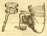 An illustration from Galeni librorum septima classis : curativum methodum tum diffuse tum breviter descriptam, victus rationem in morbis acutis, singulorum morborum facile paranda remedia, privatam quorundam morborum curationem, chirurgie constitutionem, fracturarum ac luxationum sanationem, fasciarum deniq ; & laqueorum & machinamentorum tractatum continet (1576)