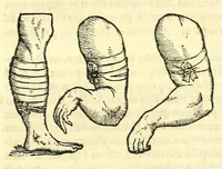 An illustration from Galeni librorum septima classis : curativum methodum tum diffuse tum breviter descriptam, victus rationem in morbis acutis, singulorum morborum facile paranda remedia, privatam quorundam morborum curationem, chirurgie constitutionem, fracturarum ac luxationum sanationem, fasciarum deniq ; & laqueorum & machinamentorum tractatum continet (1576)