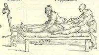 An illustration from Galeni librorum septima classis : curativum methodum tum diffuse tum breviter descriptam, victus rationem in morbis acutis, singulorum morborum facile paranda remedia, privatam quorundam morborum curationem, chirurgie constitutionem, fracturarum ac luxationum sanationem, fasciarum deniq ; & laqueorum & machinamentorum tractatum continet (1576)