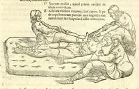 An illustration from Galeni librorum septima classis : curativum methodum tum diffuse tum breviter descriptam, victus rationem in morbis acutis, singulorum morborum facile paranda remedia, privatam quorundam morborum curationem, chirurgie constitutionem, fracturarum ac luxationum sanationem, fasciarum deniq ; & laqueorum & machinamentorum tractatum continet (1576)