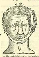 An illustration from Galeni librorum septima classis : curativum methodum tum diffuse tum breviter descriptam, victus rationem in morbis acutis, singulorum morborum facile paranda remedia, privatam quorundam morborum curationem, chirurgie constitutionem, fracturarum ac luxationum sanationem, fasciarum deniq ; & laqueorum & machinamentorum tractatum continet (1576)