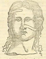 An illustration from Galeni librorum septima classis : curativum methodum tum diffuse tum breviter descriptam, victus rationem in morbis acutis, singulorum morborum facile paranda remedia, privatam quorundam morborum curationem, chirurgie constitutionem, fracturarum ac luxationum sanationem, fasciarum deniq ; & laqueorum & machinamentorum tractatum continet (1576)