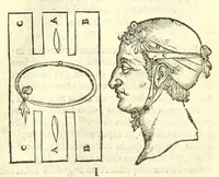 An illustration from Galeni librorum septima classis : curativum methodum tum diffuse tum breviter descriptam, victus rationem in morbis acutis, singulorum morborum facile paranda remedia, privatam quorundam morborum curationem, chirurgie constitutionem, fracturarum ac luxationum sanationem, fasciarum deniq ; & laqueorum & machinamentorum tractatum continet (1576)