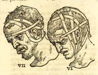 An illustration from Galeni librorum septima classis : curativum methodum tum diffuse tum breviter descriptam, victus rationem in morbis acutis, singulorum morborum facile paranda remedia, privatam quorundam morborum curationem, chirurgie constitutionem, fracturarum ac luxationum sanationem, fasciarum deniq ; & laqueorum & machinamentorum tractatum continet (1576)