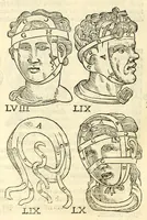 An illustration from Galeni librorum septima classis : curativum methodum tum diffuse tum breviter descriptam, victus rationem in morbis acutis, singulorum morborum facile paranda remedia, privatam quorundam morborum curationem, chirurgie constitutionem, fracturarum ac luxationum sanationem, fasciarum deniq ; & laqueorum & machinamentorum tractatum continet (1576)