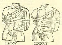 An illustration from Galeni librorum septima classis : curativum methodum tum diffuse tum breviter descriptam, victus rationem in morbis acutis, singulorum morborum facile paranda remedia, privatam quorundam morborum curationem, chirurgie constitutionem, fracturarum ac luxationum sanationem, fasciarum deniq ; & laqueorum & machinamentorum tractatum continet (1576)