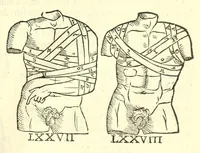 An illustration from Galeni librorum septima classis : curativum methodum tum diffuse tum breviter descriptam, victus rationem in morbis acutis, singulorum morborum facile paranda remedia, privatam quorundam morborum curationem, chirurgie constitutionem, fracturarum ac luxationum sanationem, fasciarum deniq ; & laqueorum & machinamentorum tractatum continet (1576)