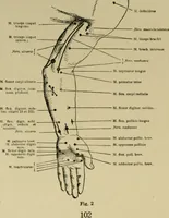 Picture 3 of 35 from An atlas of the differential diagnosis of the diseases of the nervous system; analytical and semeiological neurological charts (1914), leaf 113