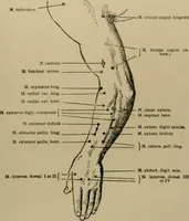 Picture 4 of 35 from An atlas of the differential diagnosis of the diseases of the nervous system; analytical and semeiological neurological charts (1914), leaf 114