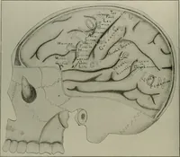 An illustration from An atlas of the differential diagnosis of the diseases of the nervous system; analytical and semeiological neurological charts (1914)