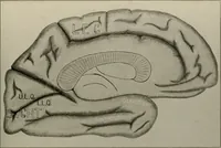 Picture 10 of 35 from An atlas of the differential diagnosis of the diseases of the nervous system; analytical and semeiological neurological charts (1914), leaf 312