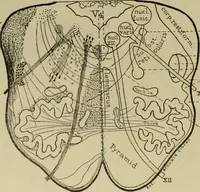 Picture 14 of 35 from An atlas of the differential diagnosis of the diseases of the nervous system; analytical and semeiological neurological charts (1914), leaf 315