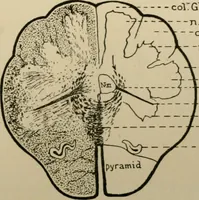 An illustration from An atlas of the differential diagnosis of the diseases of the nervous system; analytical and semeiological neurological charts (1914)