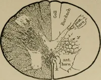 Picture 16 of 35 from An atlas of the differential diagnosis of the diseases of the nervous system; analytical and semeiological neurological charts (1914), leaf 316