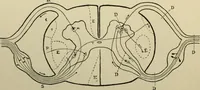 Picture 17 of 35 from An atlas of the differential diagnosis of the diseases of the nervous system; analytical and semeiological neurological charts (1914), leaf 317