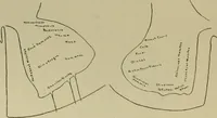 Picture 18 of 35 from An atlas of the differential diagnosis of the diseases of the nervous system; analytical and semeiological neurological charts (1914), leaf 317