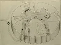 Picture 19 of 35 from An atlas of the differential diagnosis of the diseases of the nervous system; analytical and semeiological neurological charts (1914), leaf 318