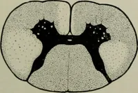 Picture 20 of 35 from An atlas of the differential diagnosis of the diseases of the nervous system; analytical and semeiological neurological charts (1914), leaf 319