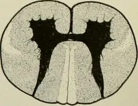 Picture 22 of 35 from An atlas of the differential diagnosis of the diseases of the nervous system; analytical and semeiological neurological charts (1914), leaf 319