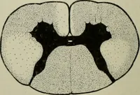 An illustration from An atlas of the differential diagnosis of the diseases of the nervous system; analytical and semeiological neurological charts (1914)