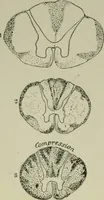 Picture 24 of 35 from An atlas of the differential diagnosis of the diseases of the nervous system; analytical and semeiological neurological charts (1914), leaf 319