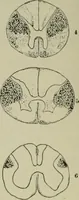 Picture 25 of 35 from An atlas of the differential diagnosis of the diseases of the nervous system; analytical and semeiological neurological charts (1914), leaf 319
