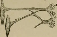 Picture 27 of 35 from An atlas of the differential diagnosis of the diseases of the nervous system; analytical and semeiological neurological charts (1914), leaf 320