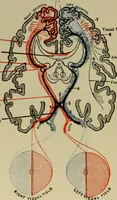 Picture 34 of 35 from An atlas of the differential diagnosis of the diseases of the nervous system; analytical and semeiological neurological charts (1914), leaf 325