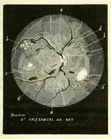 Picture 14 of 17 from Du diagnostic des maladies des yeux par la chromatoscopie rétinienne : précédé d'une étude sur les lois physiques et physiologiques des couleurs / par X. Galezowski (1868), leaf 187