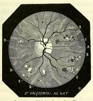 Picture 15 of 17 from Du diagnostic des maladies des yeux par la chromatoscopie rétinienne : précédé d'une étude sur les lois physiques et physiologiques des couleurs / par X. Galezowski (1868), leaf 195