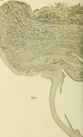 An illustration from Das Sarkom des Auges [electronic resource] (1900)