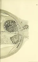 An illustration from Das Sarkom des Auges [electronic resource] (1900)